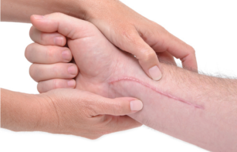 Treatment For Painful Or Stiff Scar Tissue | Elite Health And Fitness